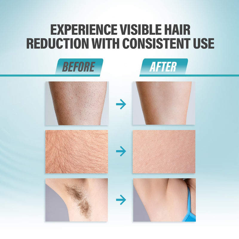Herbishh IPL Laser Hair Removal Device