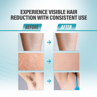 Herbishh IPL Laser Hair Removal Device